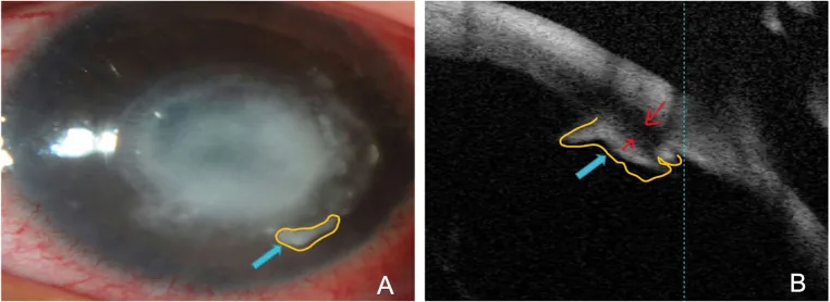 Wessely免疫リングの細隙灯写真と前眼部OCT