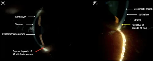 Kayser-Fleischer ringと類似所見の比較写真