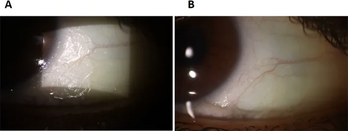 XerophthalmiaのBitot斑を示す細隙灯写真