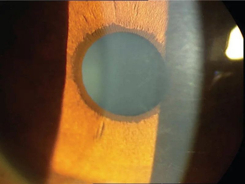 Acquired ectropion uveaeの細隙灯写真