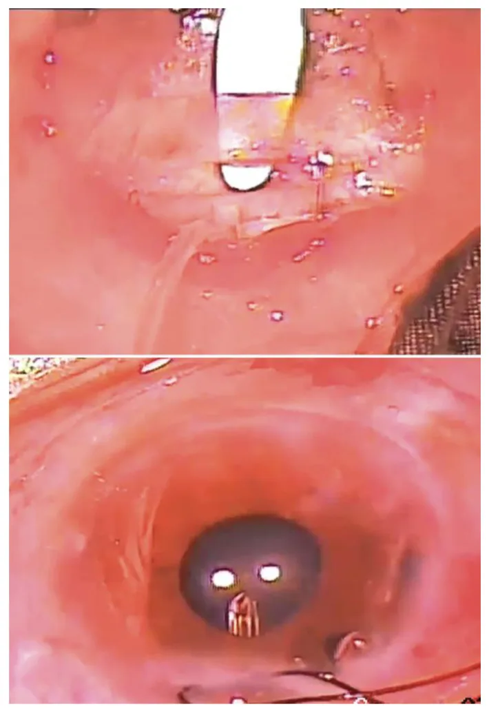 Ahmed ClearPathデバイスの術中写真