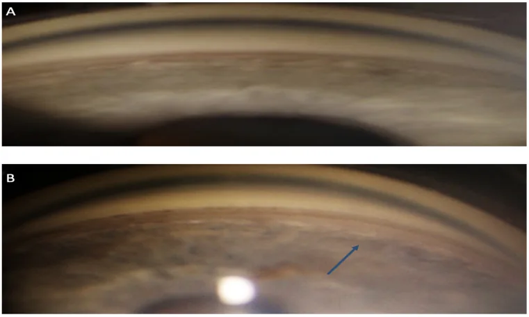 隅角後退緑内障の隅角鏡所見