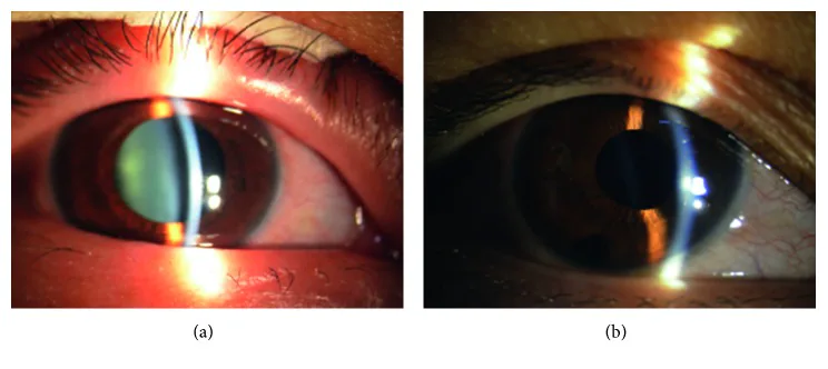 房水迷入症候群の術前後比較