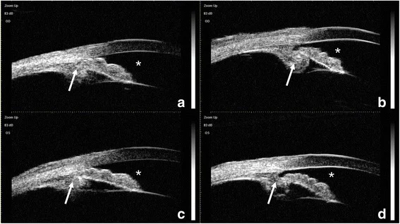 Immagini UBM (a–d): camera anteriore poco profonda e processi ciliari e radice dell'iride ruotati anteriormente