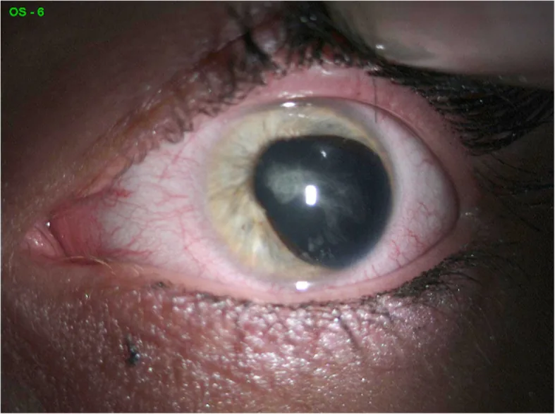 Axenfeld-Rieger症候群のコレクトピア