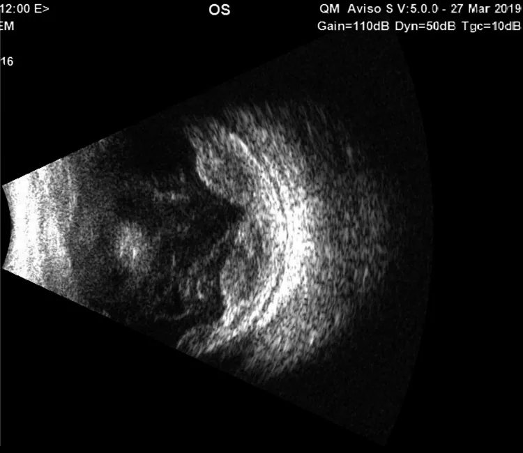 Blind painful eye のBスキャン像