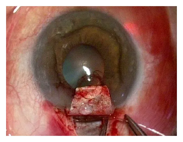 CanaloplastyにおけるSchlemm管カニュレーション