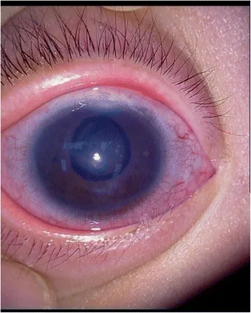 小児緑内障でみられる角膜浮腫とHaab線