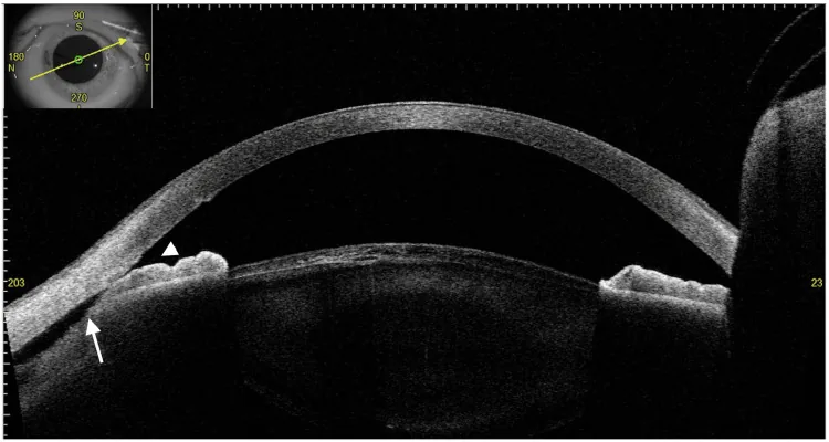 Cyclodialysis cleft のAS-OCT像