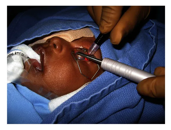 小児緑内障に対する毛様体光凝固の術中写真