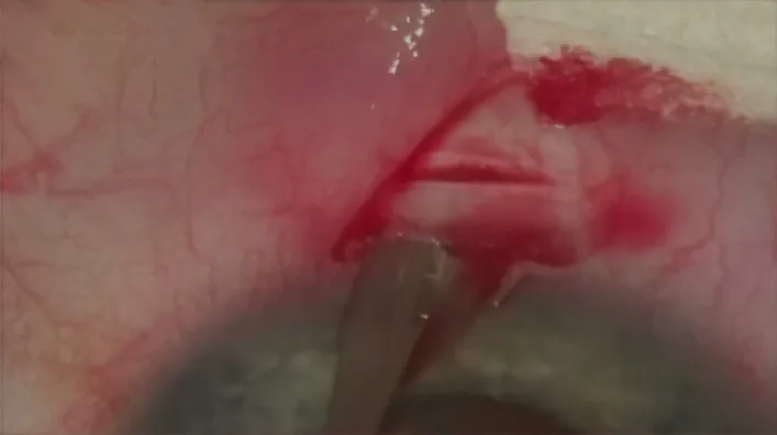 Deep sclerectomy の強膜フラップ作成