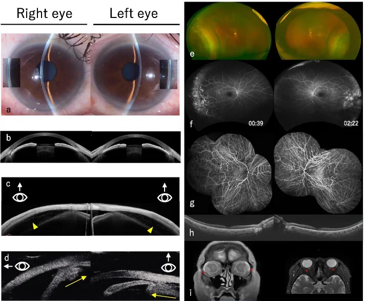 Immagini di esami multimodali del glaucoma acuto ad angolo chiuso indotto da farmaci