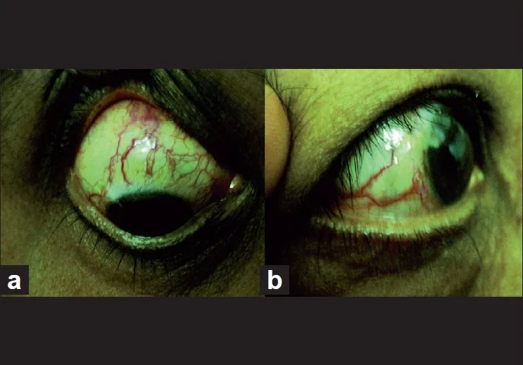 上強膜静脈圧上昇でみられる拡張血管