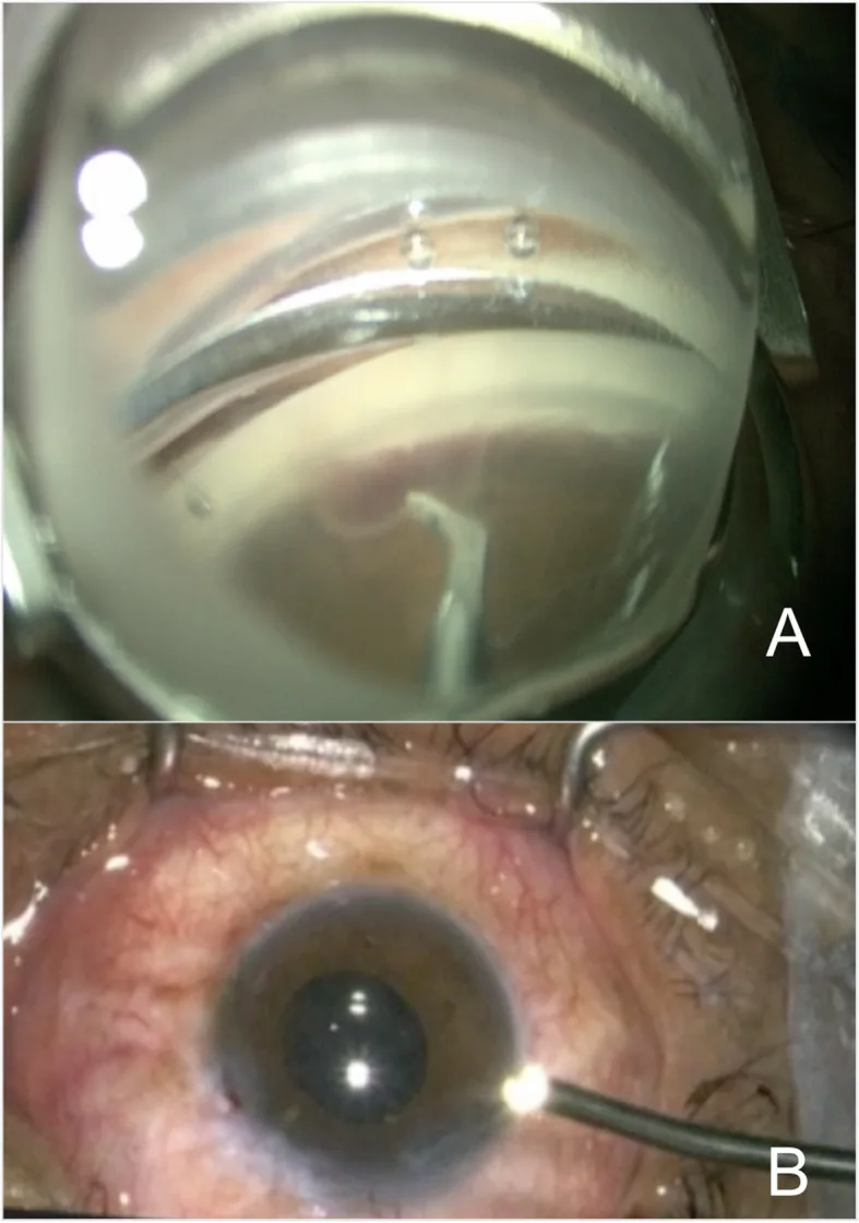 Endoscopic cyclophotocoagulation の術中像