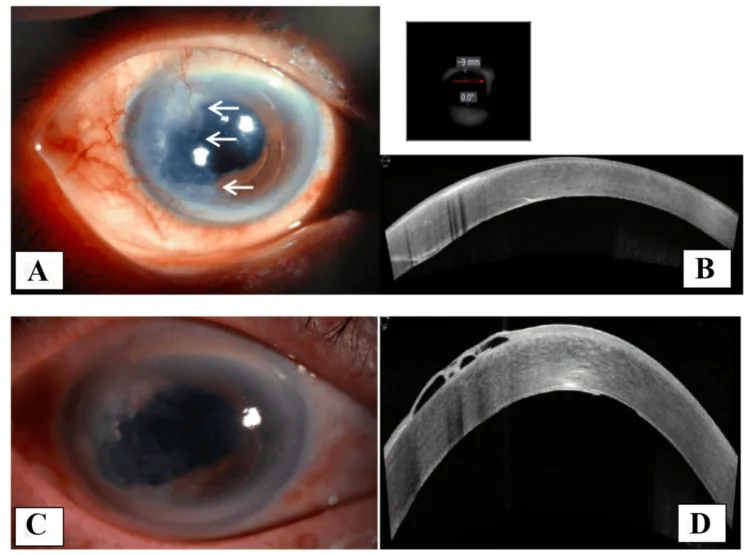 Epithelial downgrowth の前眼部写真とAS-OCT