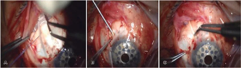 Glaucoma drainage device 留置の術中手順