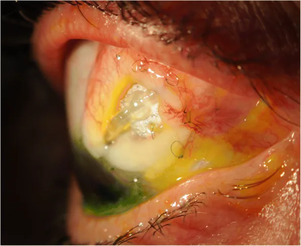 グラウコーマチューブ露出の臨床写真
