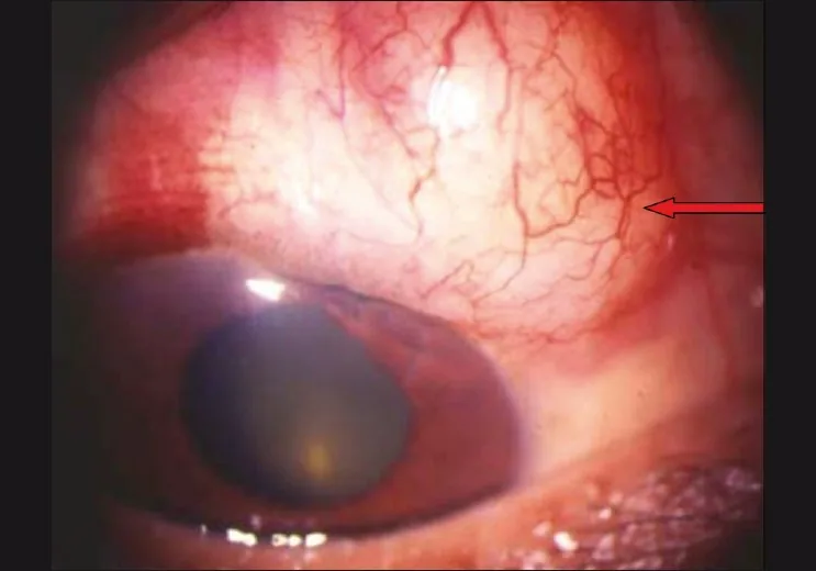 Goniopuncture 後の被包化濾過胞