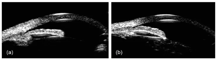 Potongan melintang segmen anterior pada sudut sempit (a) dan bentuk iris plateau (b) yang terlihat dengan biomikroskopi ultrasonografi (UBM). Pada (b), badan siliaris mendorong akar iris yang datar ke depan.