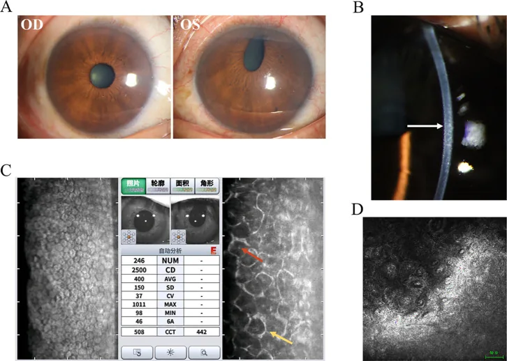 Iridocorneal endothelial syndrome の臨床像と補助検査像