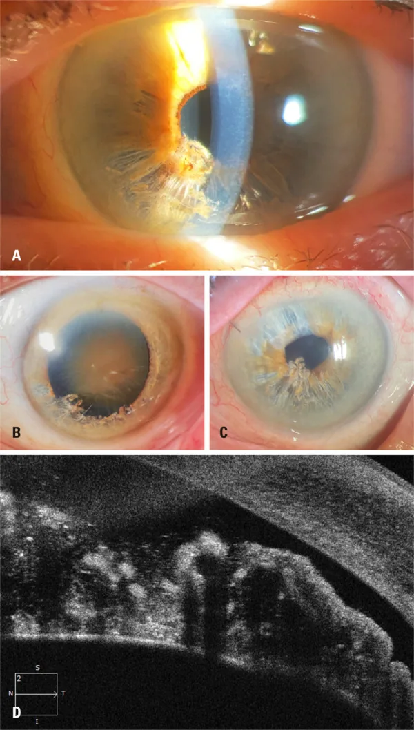 Iridoschisis の細隙灯写真と UBM 所見