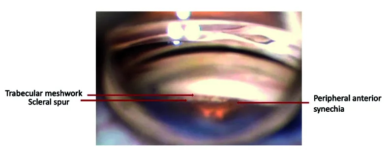 レーザー虹彩切開後評価で用いる隅角鏡所見