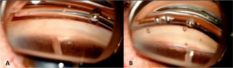 Laser trabeculotomy の術中ゴニオ像