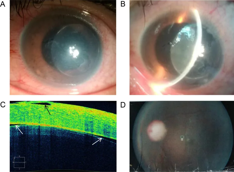 Lens-induced glaucoma の臨床所見