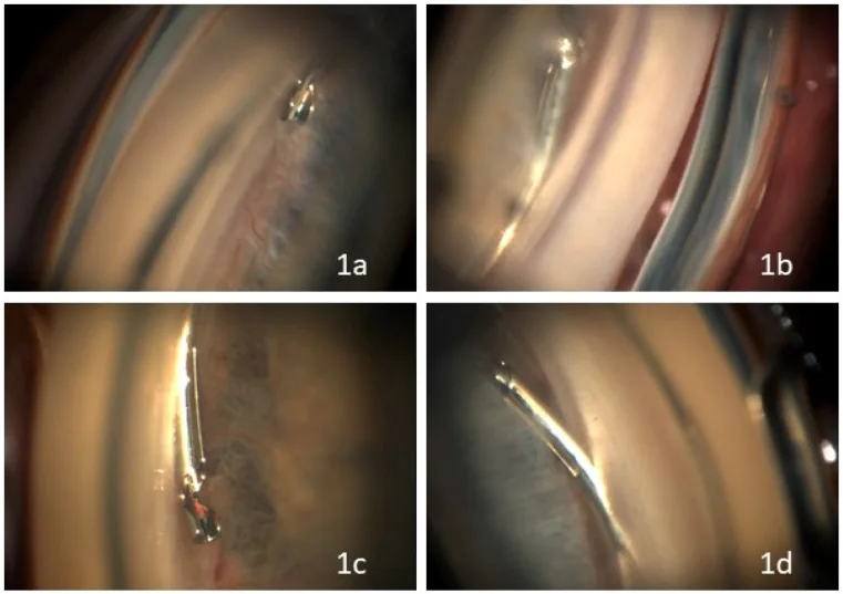 MIGS 後のマイクロステント位置確認像