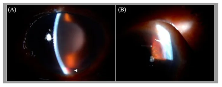 Neovascular glaucoma の細隙灯所見
