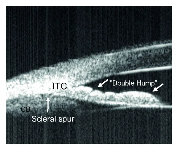 Outflow pathway imaging における UBM double-hump sign