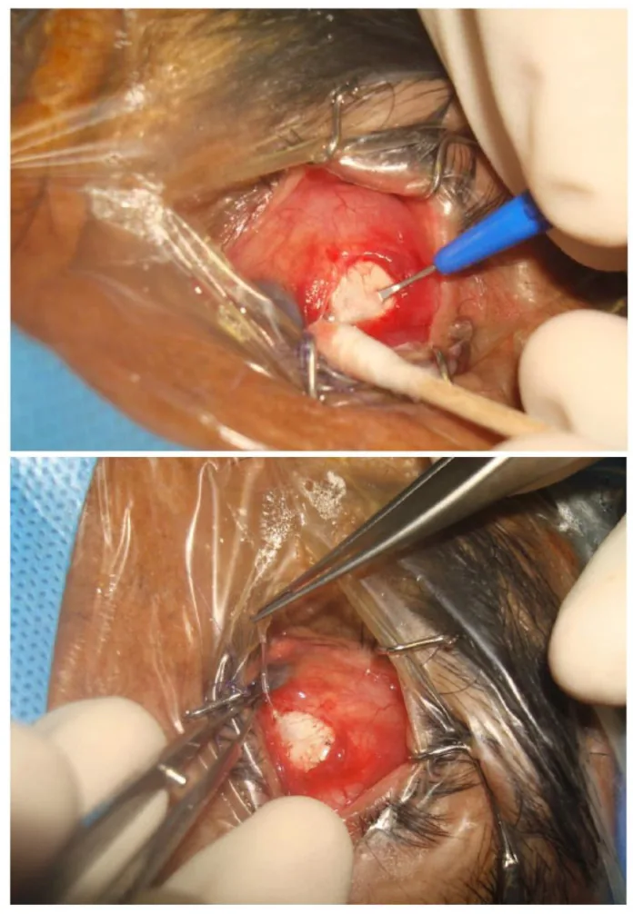 Paul glaucoma implant の術中写真
