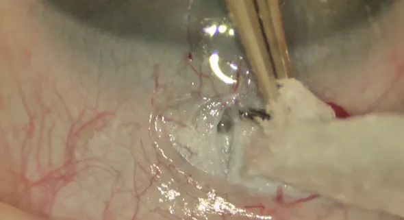 小児緑内障術の術中写真