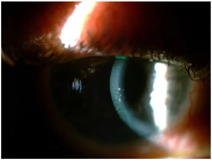 小児ぶどう膜炎緑内障の細隙灯所見