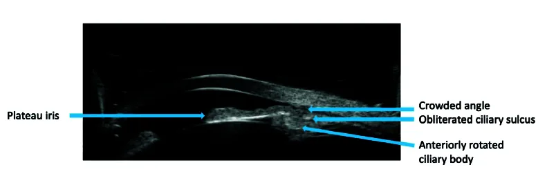 UBM-Bild des Plateau-Iris-Syndroms. Zeigt nach vorne rotierte Ziliarfortsätze und einen verengten Winkel.