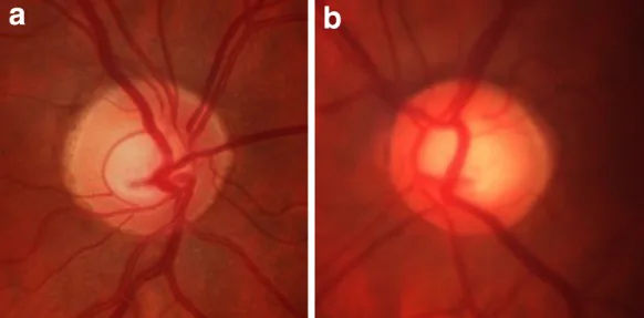 Fotografia del fondo oculare di entrambi i dischi ottici che mostra una neuropatia ottica glaucomatosa asimmetrica