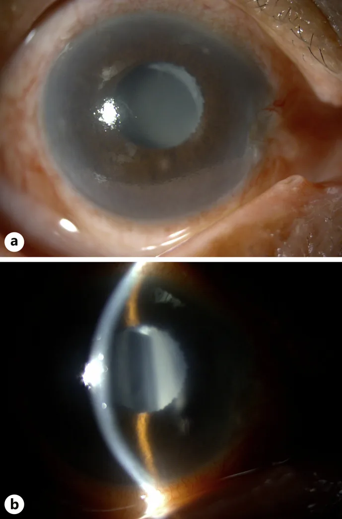 続発閉塞隅角の前眼部写真と断面像