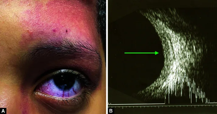 Sturge-Weber syndrome の顔面所見と眼球超音波像