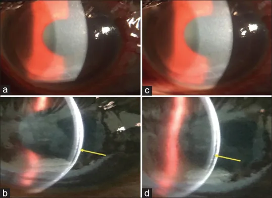 屈折矯正手術後の界面液貯留を示す前眼部所見
