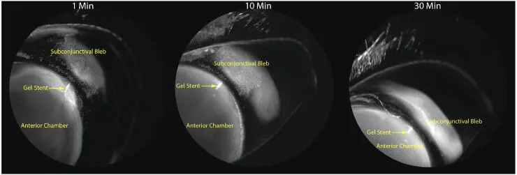 XEN gel stent 後の bleb を示す前眼部断面像
