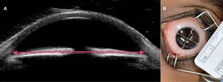 Ultrasound biomicroscopy measurement of corneal diameter and angle-to-angle distance