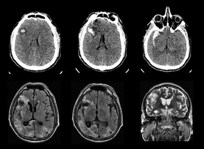 Hình ảnh CT/MRI của nhồi máu thùy chẩm hai bên gây hội chứng Anton