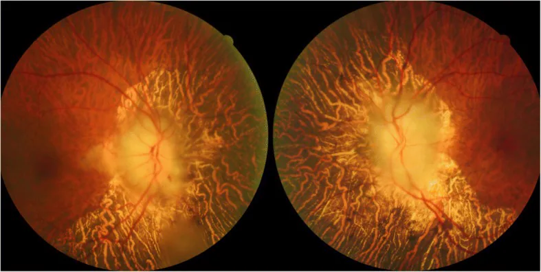 Fotografia de fundo de olho de neuropatia óptica isquêmica anterior arterítica. Observam-se papilas ópticas pálidas e edemaciadas em ambos os olhos.