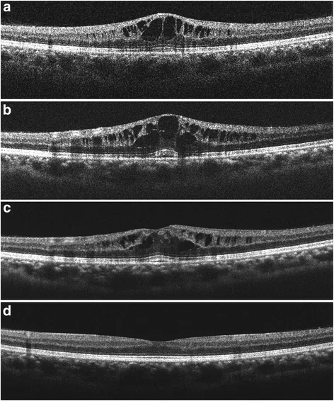 ?????????????????OCT?