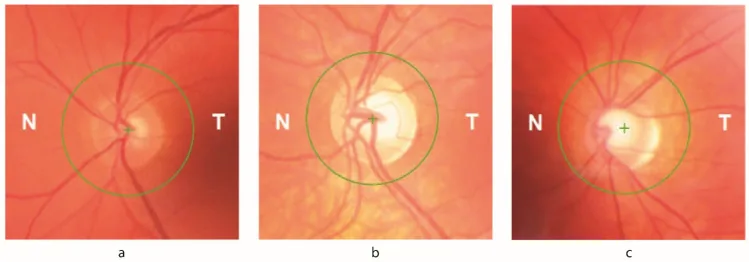 Friedreich??????????????????