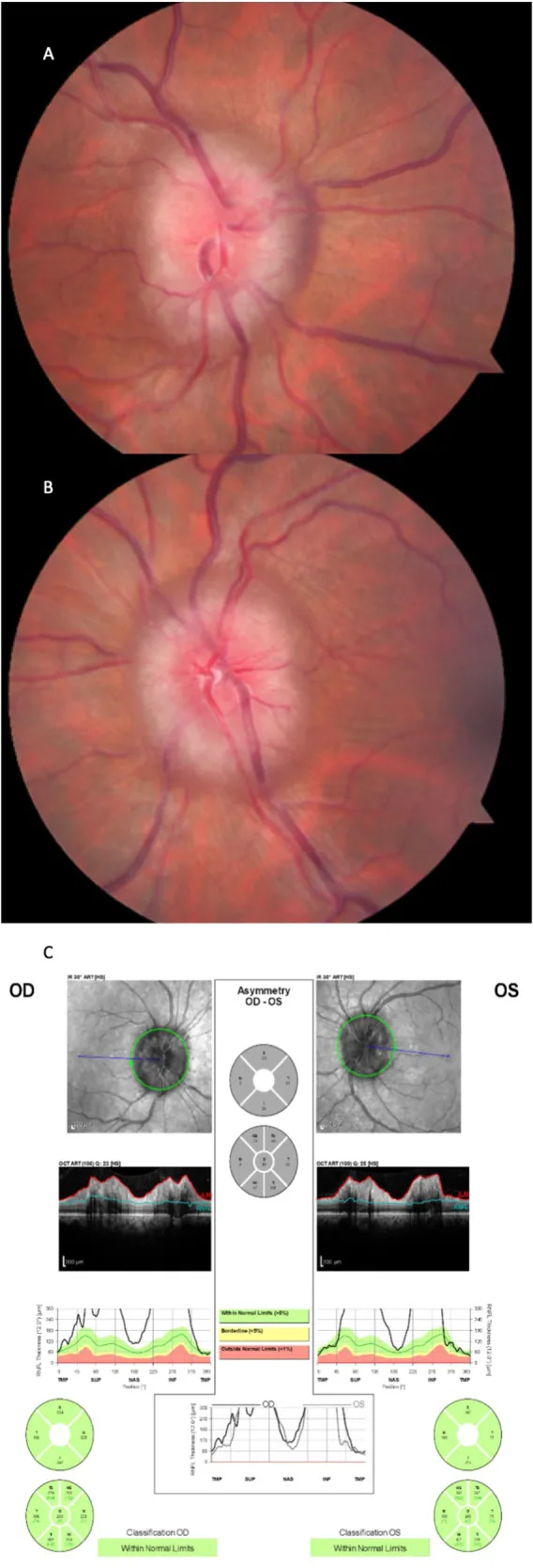 ??????????????????RNFL??