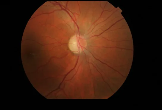 Harding disease??????????