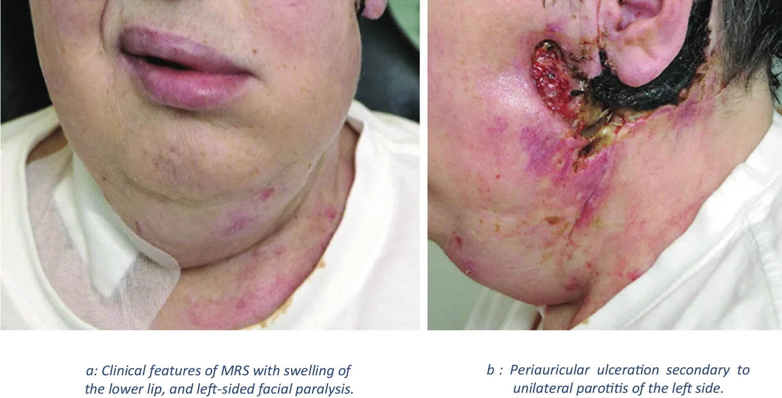 Melkersson-Rosenthal???????????????