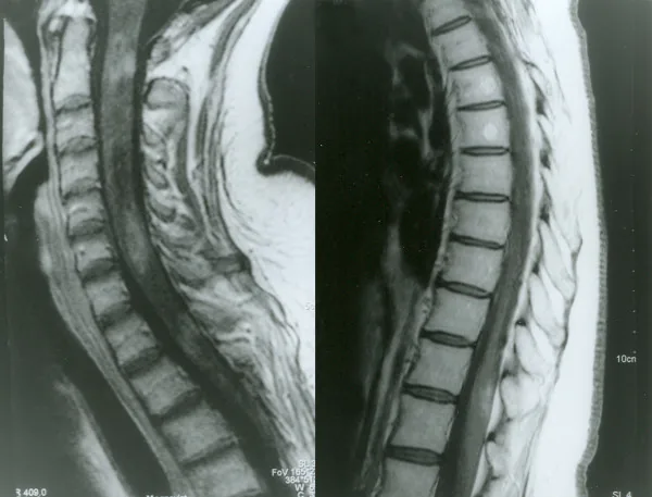 視神経脊髄炎における脊髄の造影MRI