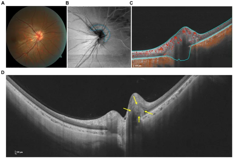 PHOMS??????OCTA?OCT??